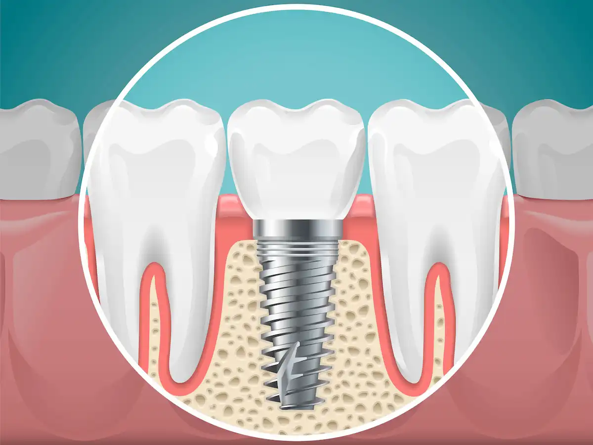 Bone Grafting